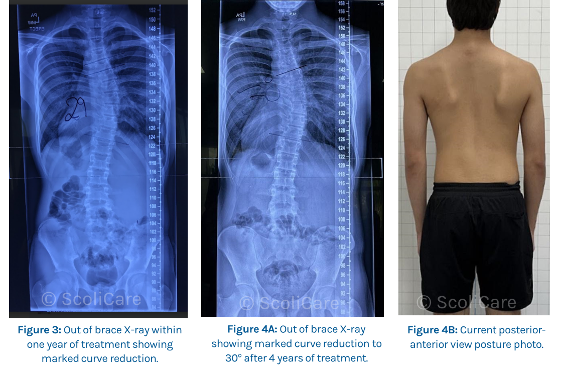 Case 12 Year Old Male Adolescent Patient ScoliBrace