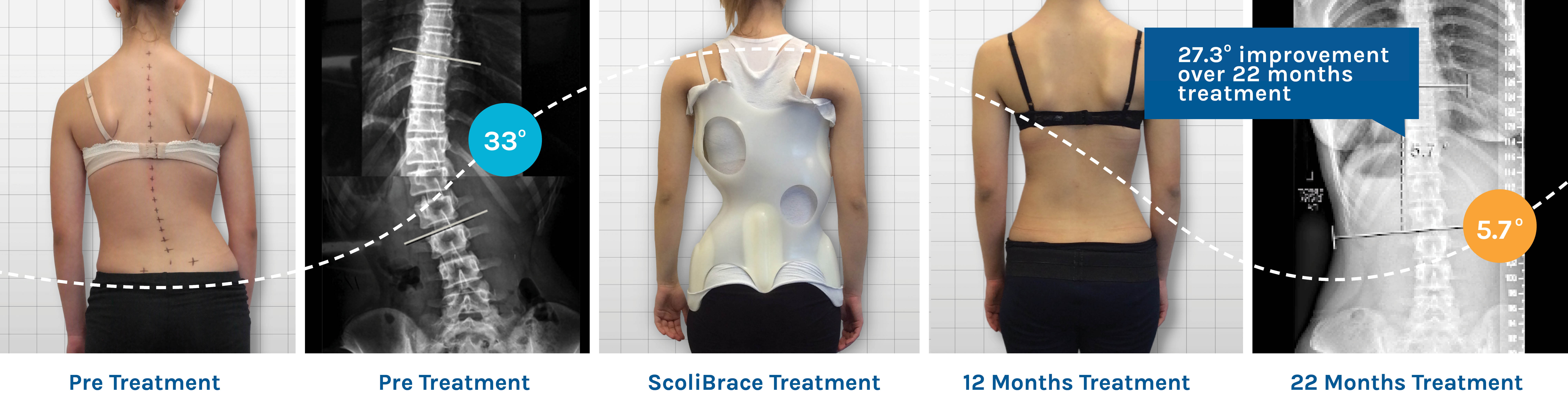 Scolibrace is patient friendly and gets results