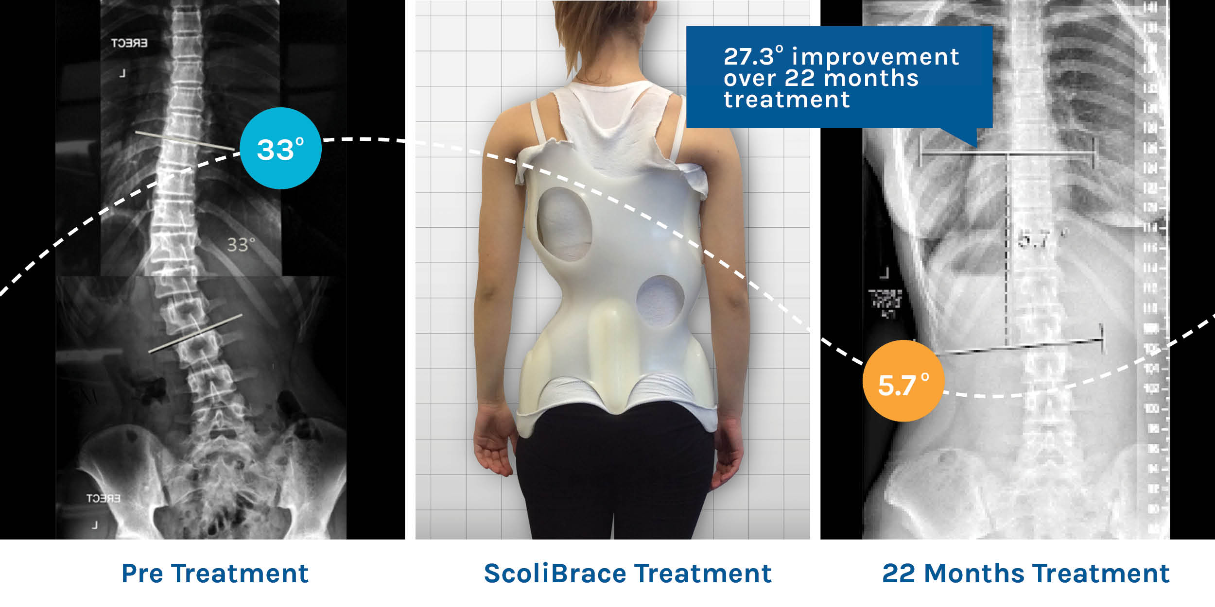 Scolibrace is patient friendly and gets results