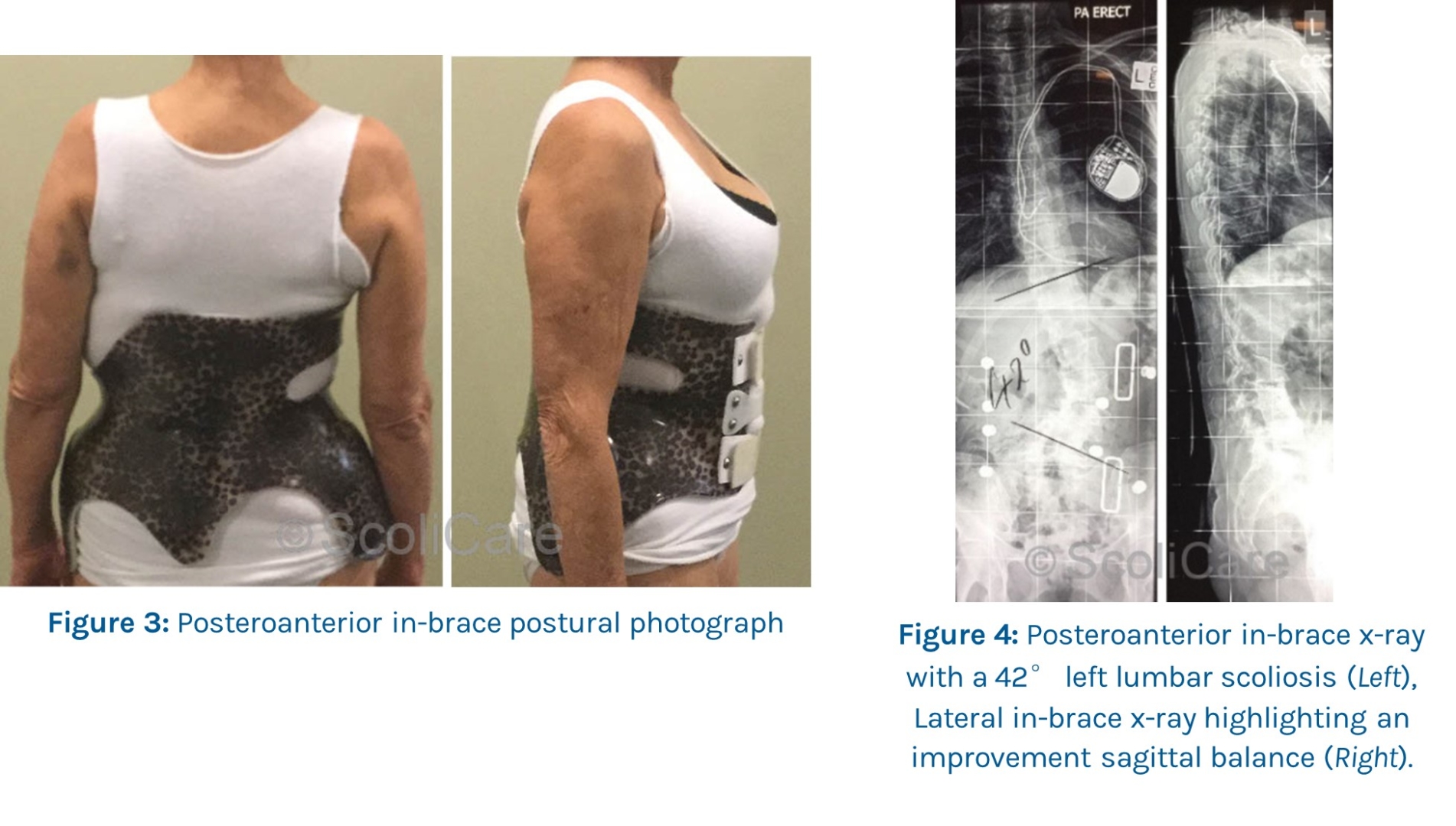 Case Study: Postural improvement, improved mobility in patient –ScoliBrace
