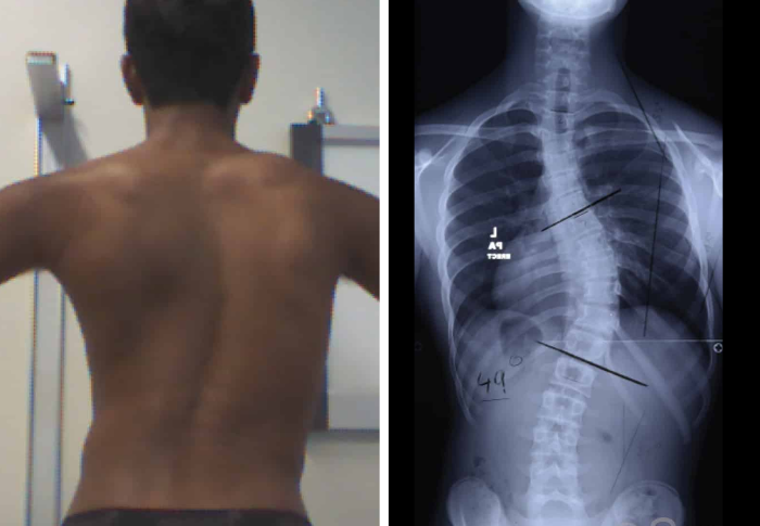 case-study-reduction-of-severe-scoliosis-in-14-year-old-male-scolibrace