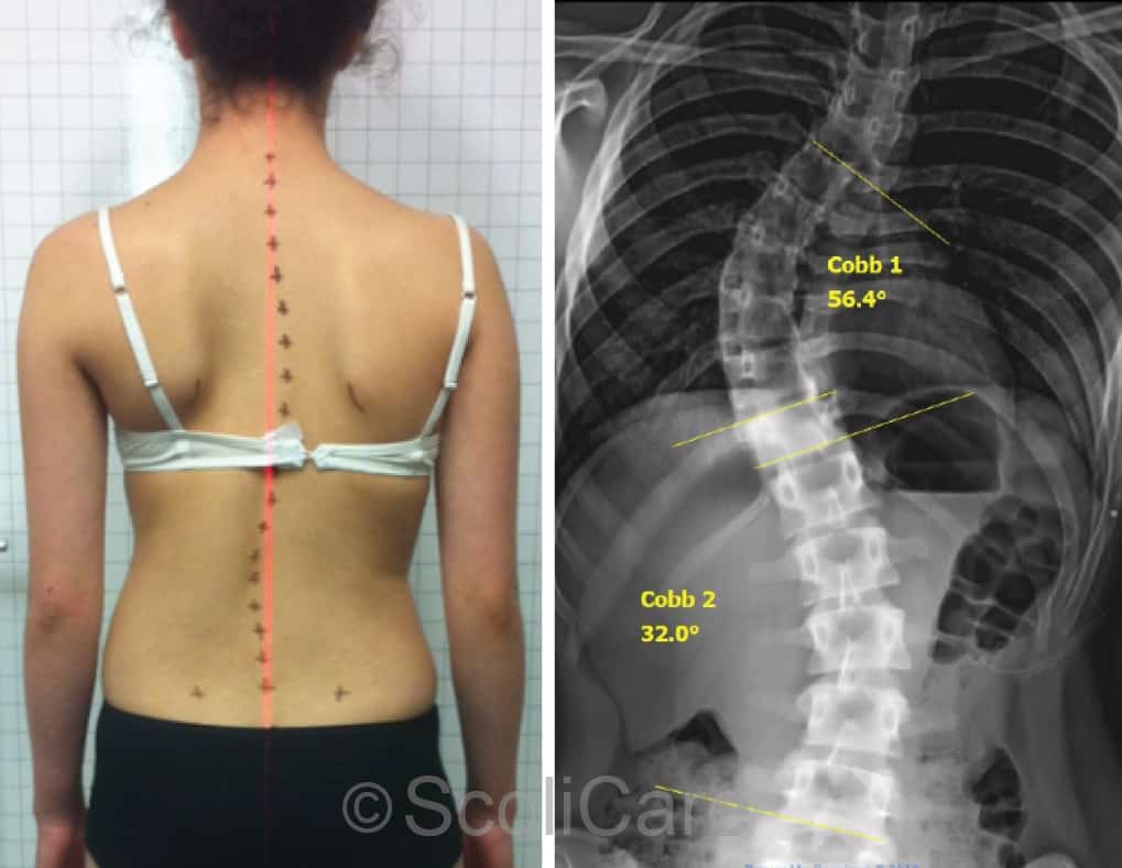 What Are the Signs of Scoliosis?