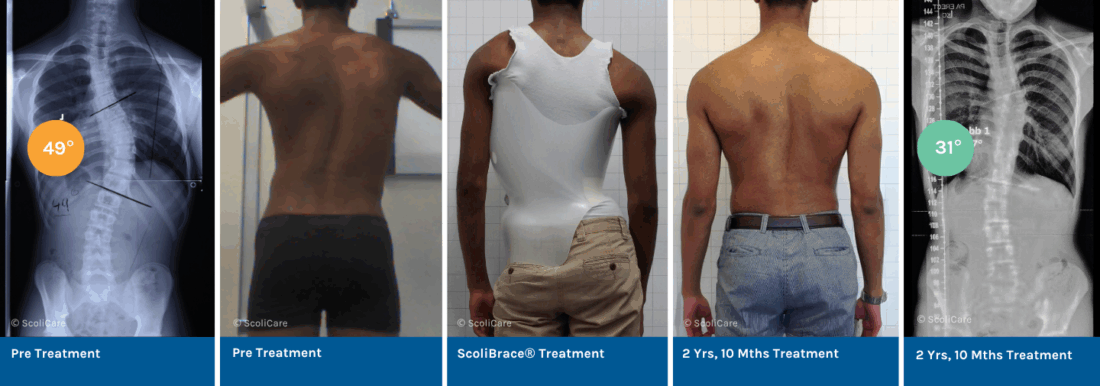Reduction of a severe scoliosis using ScoliBrace® and ScoliBalance® in a 14-year-old male
