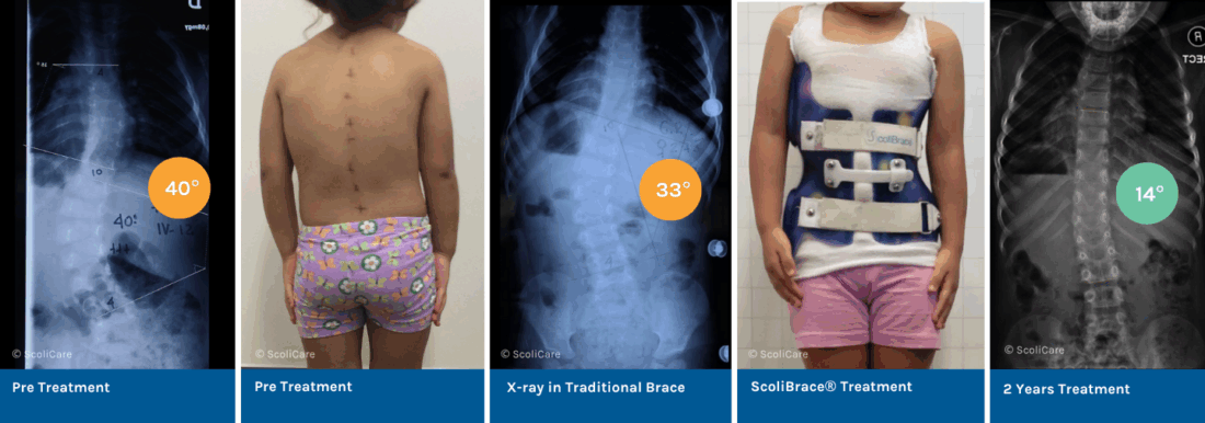 Treatment of an Infantile Scoliosis with ScoliBrace® and ScoliBalance®.
