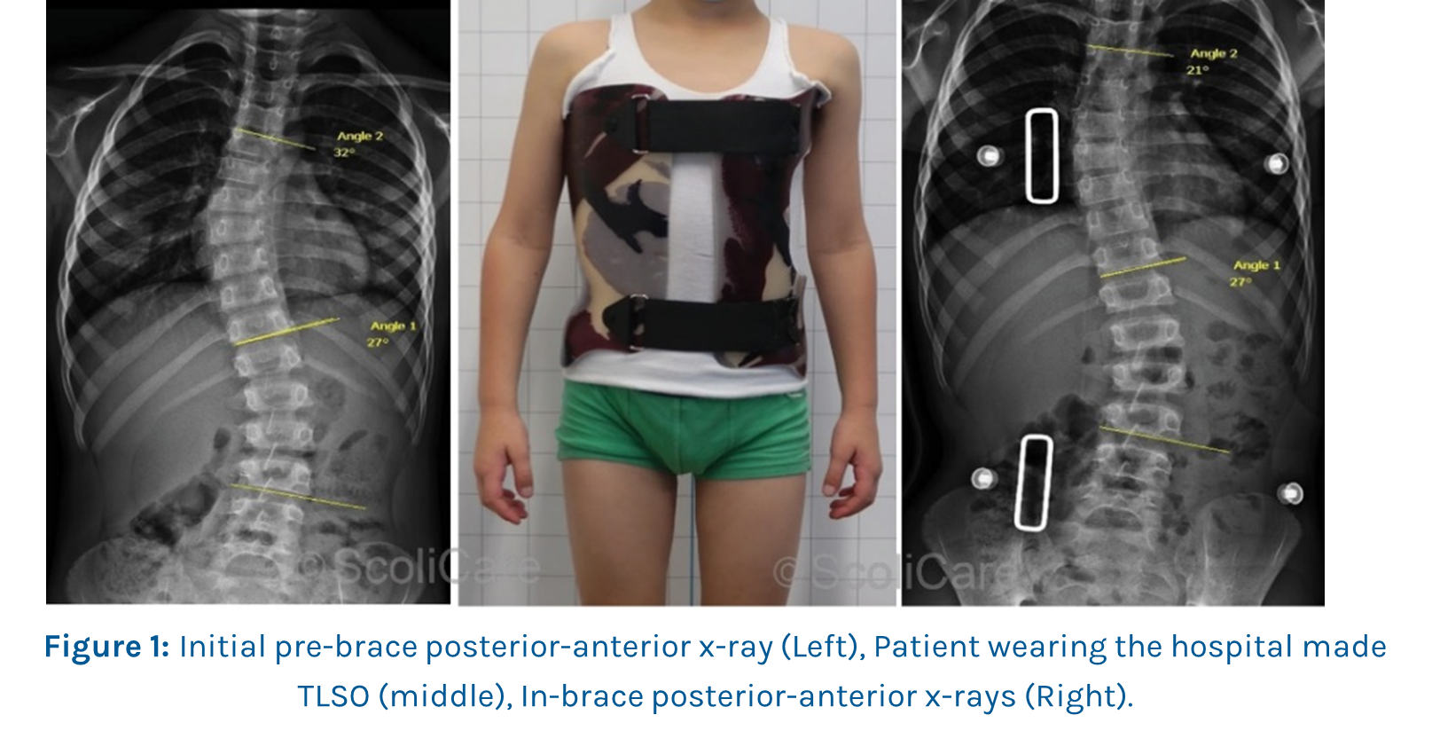 Case Study Inbrace correction with a custom scoliosis brace ScoliBrace