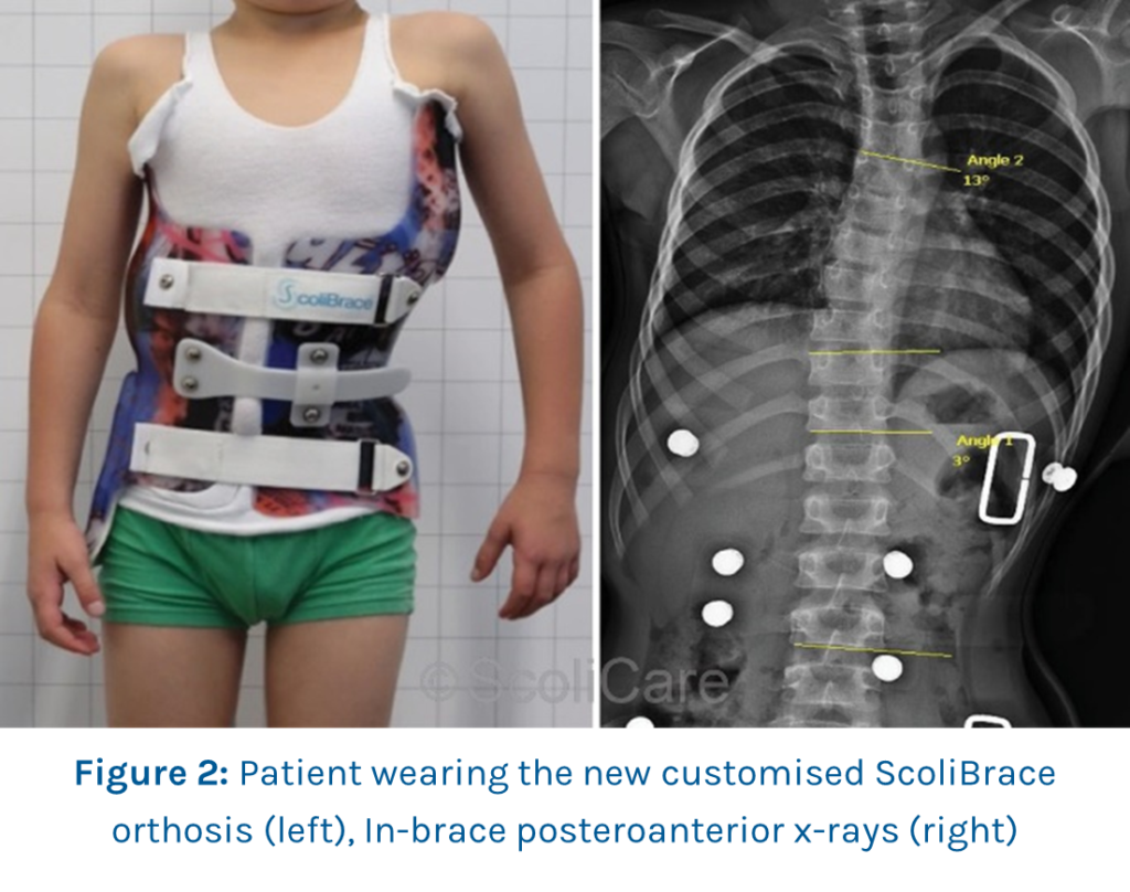 Case Study Inbrace correction with a custom scoliosis brace ScoliBrace