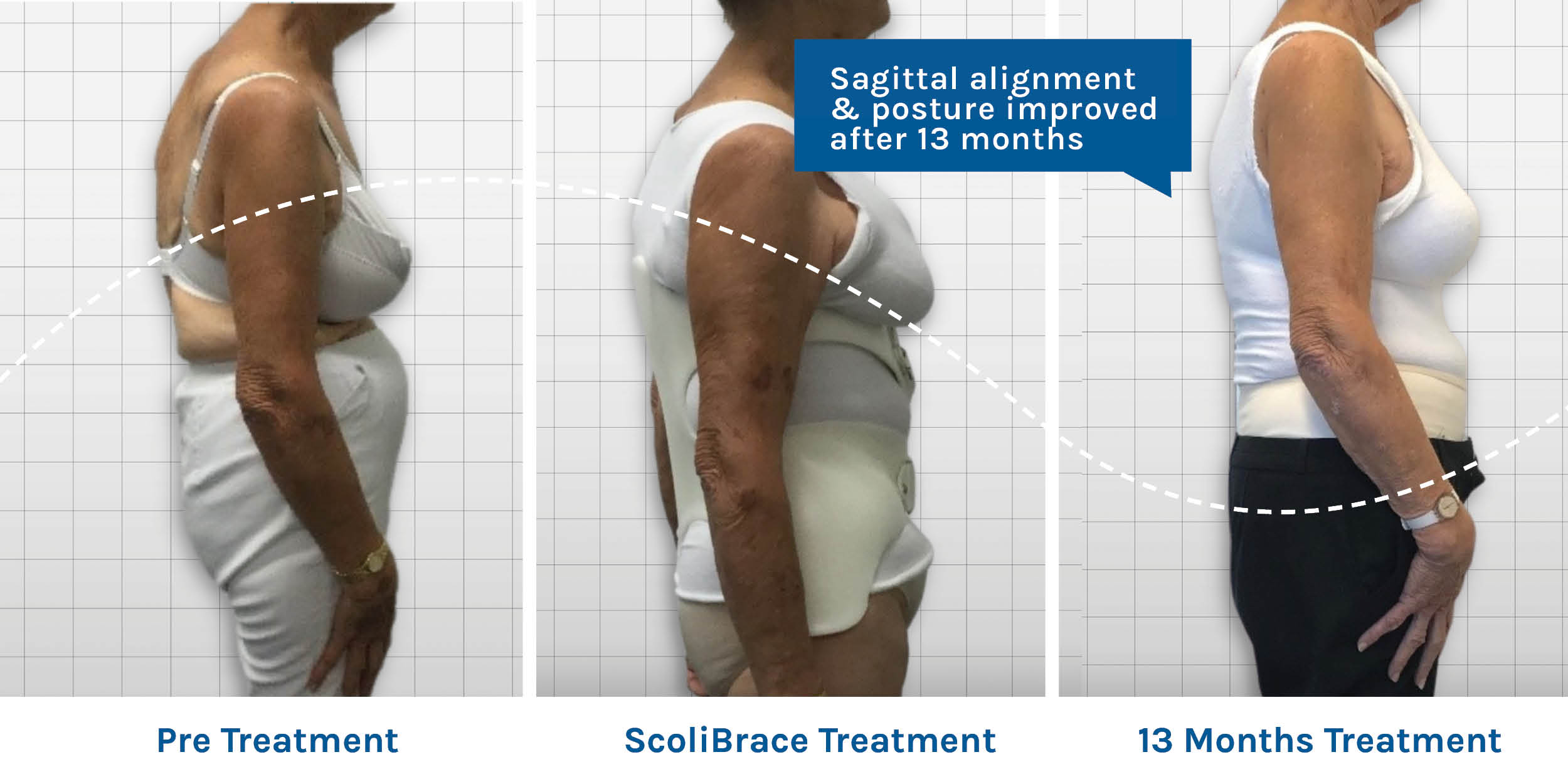 ScoliBrace is patient friendly and gets results