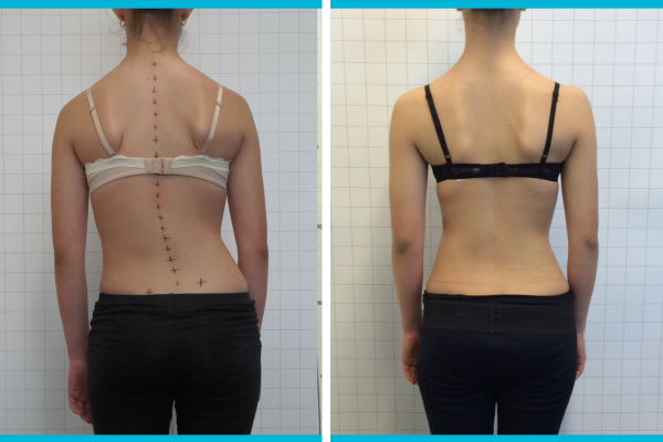 13 y/o Female – 33° Thoracolumbar Scoliosis – ScoliBrace