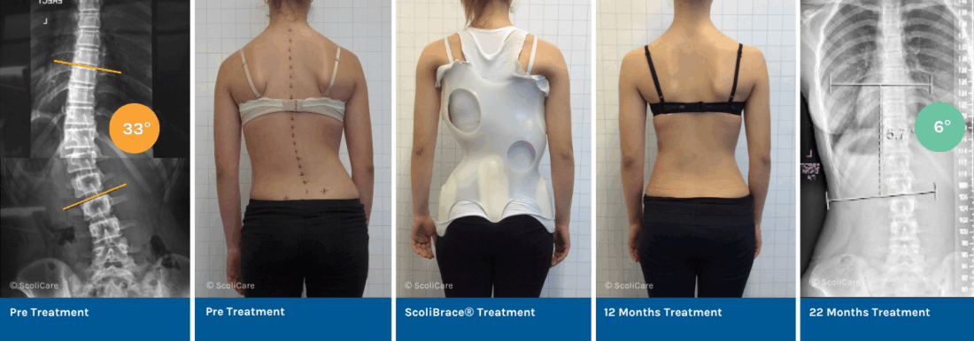 Correction of a 33° Thoracolumbar Scoliosis with ScoliBrace® and ScoliBalance®