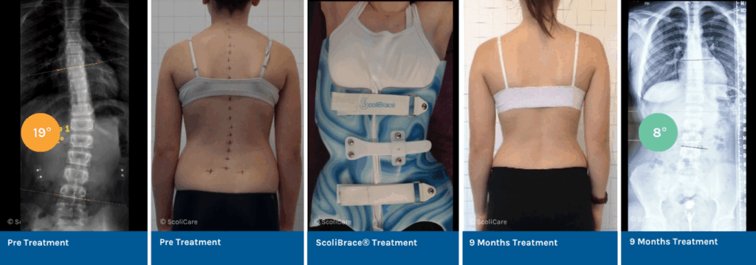 Correction of a Moderate Thoracolumbar Scoliosis Using ScoliNight® and ScoliBalance®