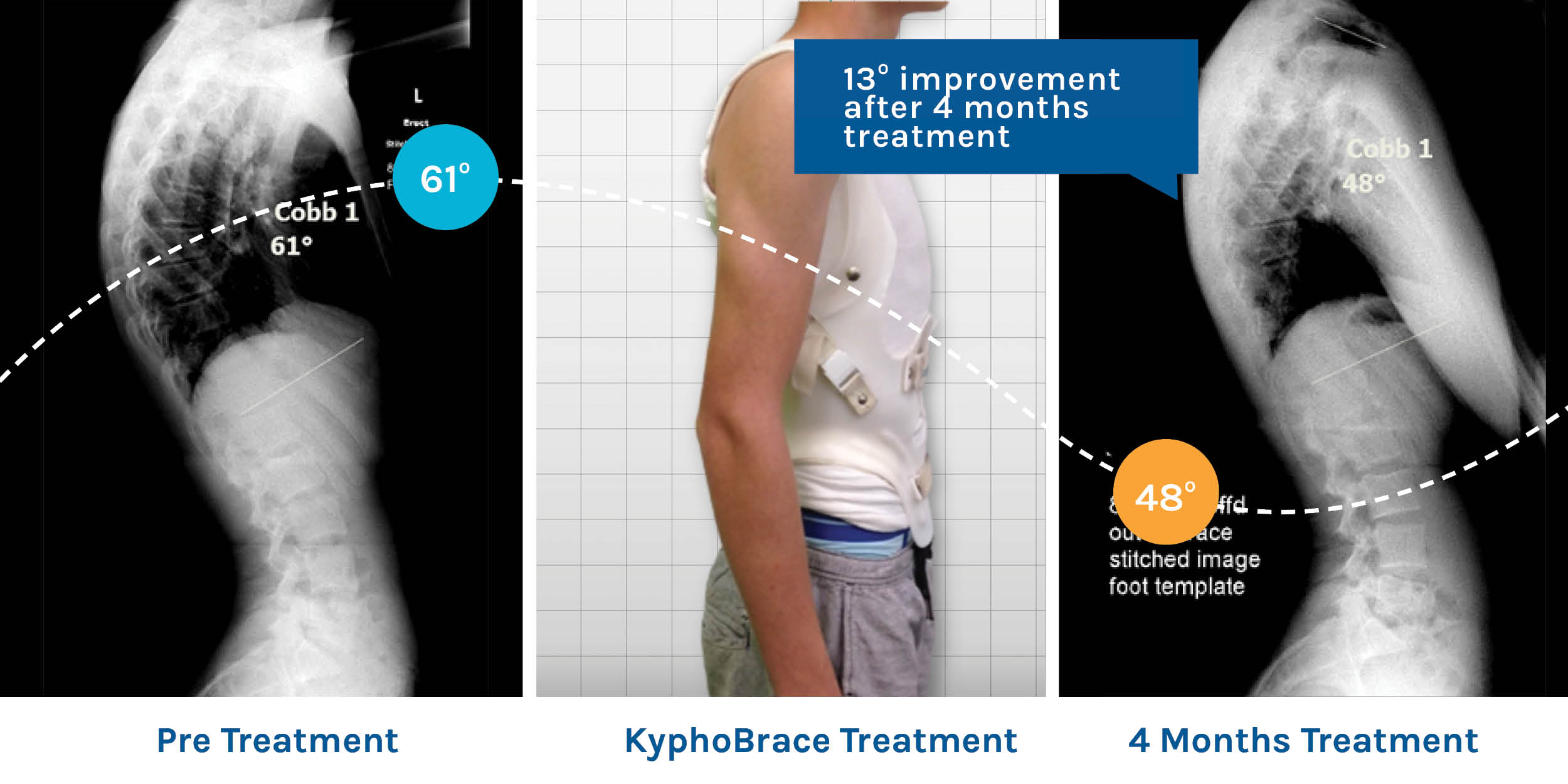 KyphoBrace is patient friendly and gets results