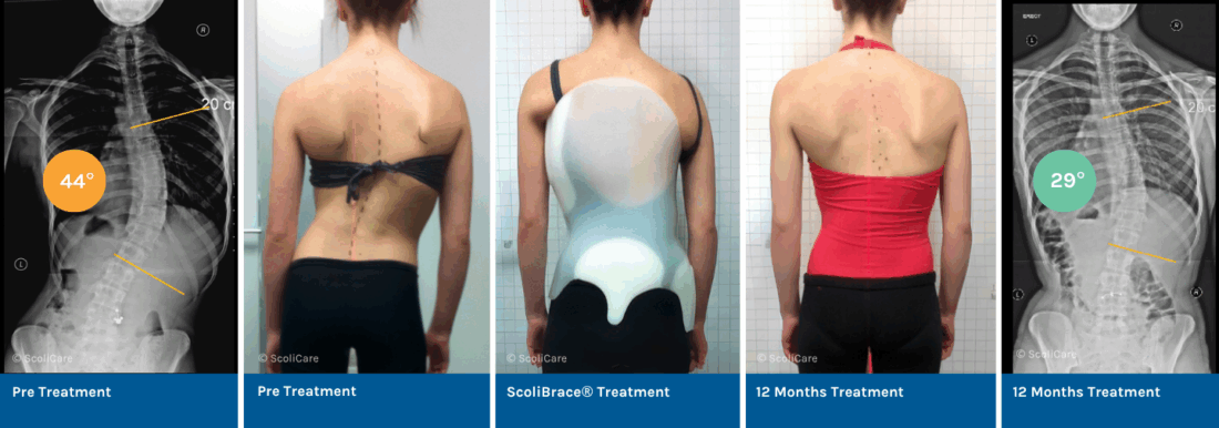 Reduction of a large thoracic scoliosis in a in a Ballet Dancer with ScoliBrace® and ScoliBalance®