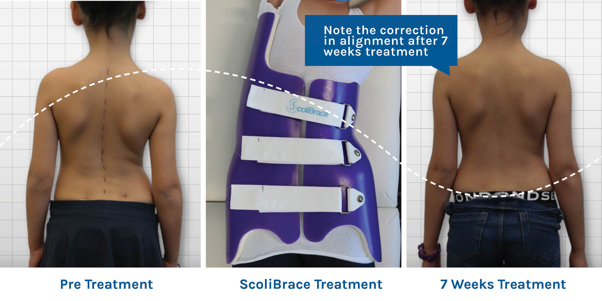 ScoliNight truly 3D custom made hyper-corrective brace designed specifically for night time wear