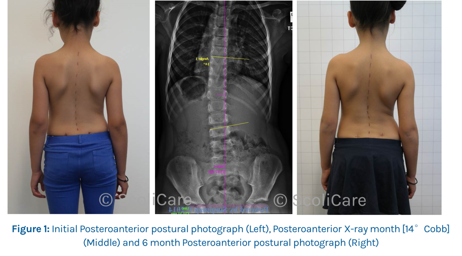 case-6-year-old-female-juvenile-patient-scolibrace