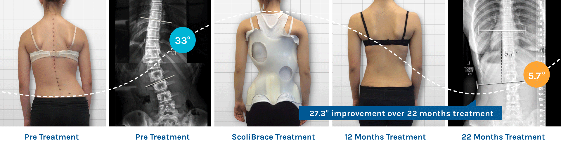 Back Brace for Scoliosis, Scoliosis Brace