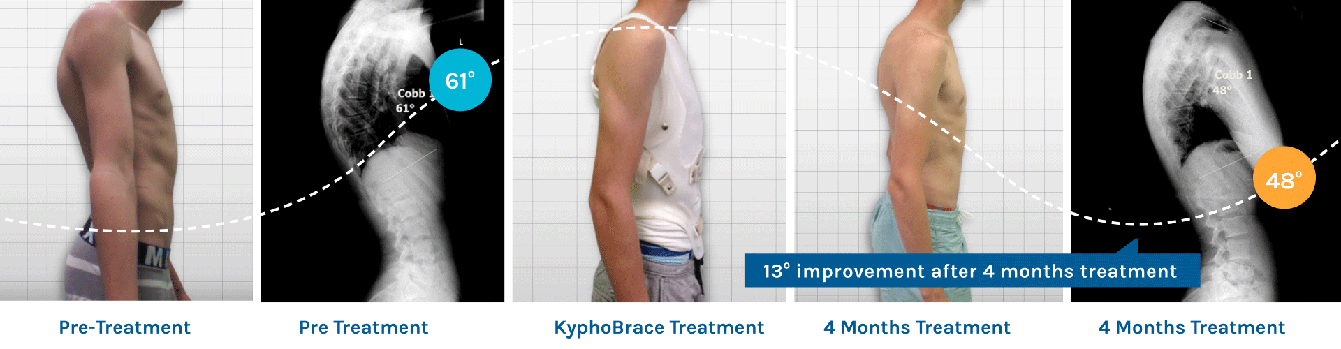 KyphoBrace is patient friendly and gets results
