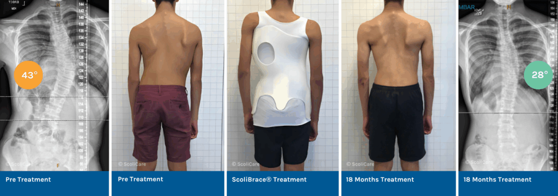 Correction of Severe Adolescent Idiopathic Scoliosis Using ScoliBrace® and ScoliBalance®