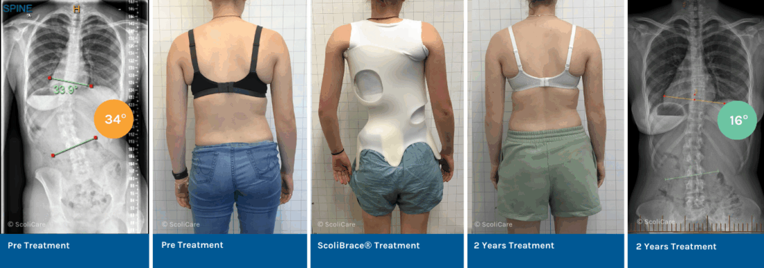 Reduction of Moderate Thoracolumbar Scoliosis Using ScoliBrace® and ScoliBalance®