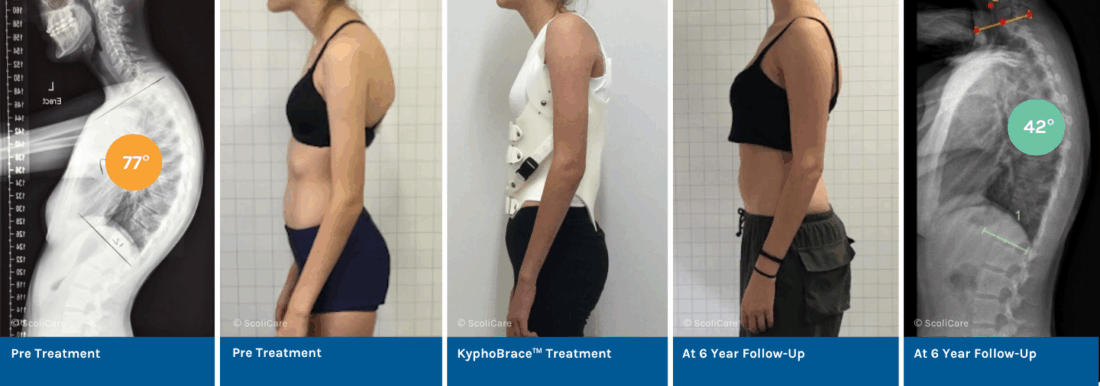 Managing Adolescent Scheurmann’s Hyperkyphosis with KyphoBrace™ and ScoliBalance®