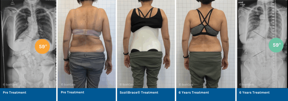 Managing Adolescent Idiopathic Scoliosis in the Adult with ScoliBrace® and ScoliBalance®