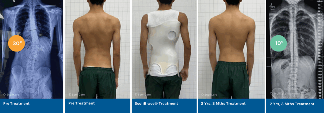 Correction of a 30° Thoracolumbar Scoliosis with ScoliBrace® and ScoliBalance®