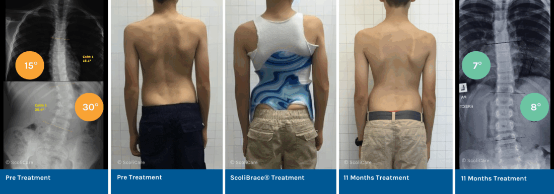 Resolution of Juvenile Idiopathic Scoliosis Using ScoliBrace® and ScoliBalance® (2)